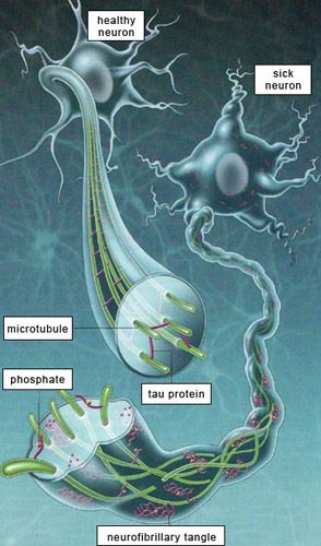 An illustration of amyloid plaques and neurofibrillary tangles formed in the brain. An illustration of amyloid plaques and neurofibrillary tangles formed in the brain.